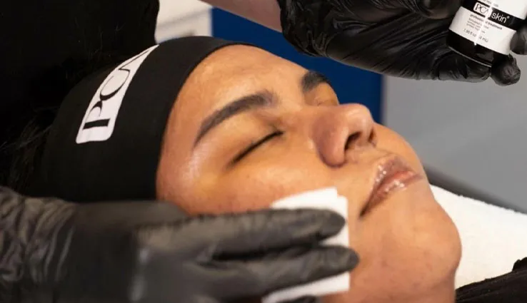 Woman's face having a peel applied via cloth squares.