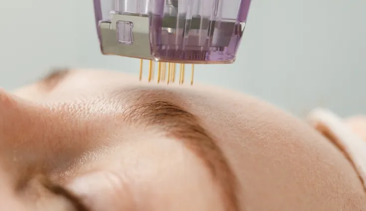 Close-up of a woman receiving a microneedling treatment on her forehead