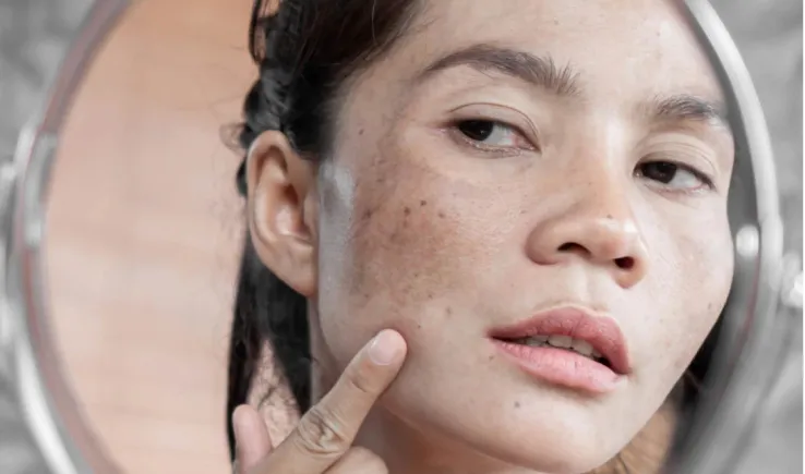 An in Depth Look at Melasma Course (1)