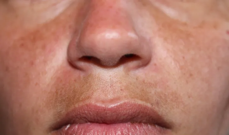 Melasma Also Called Mask Page