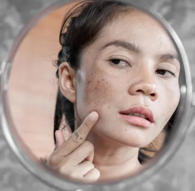 An in Depth Look at Melasma Course Hp