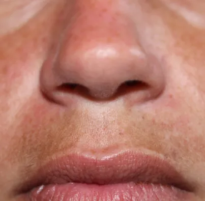 Melasma Also Called Mask Card