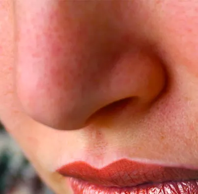 What is rosacea?